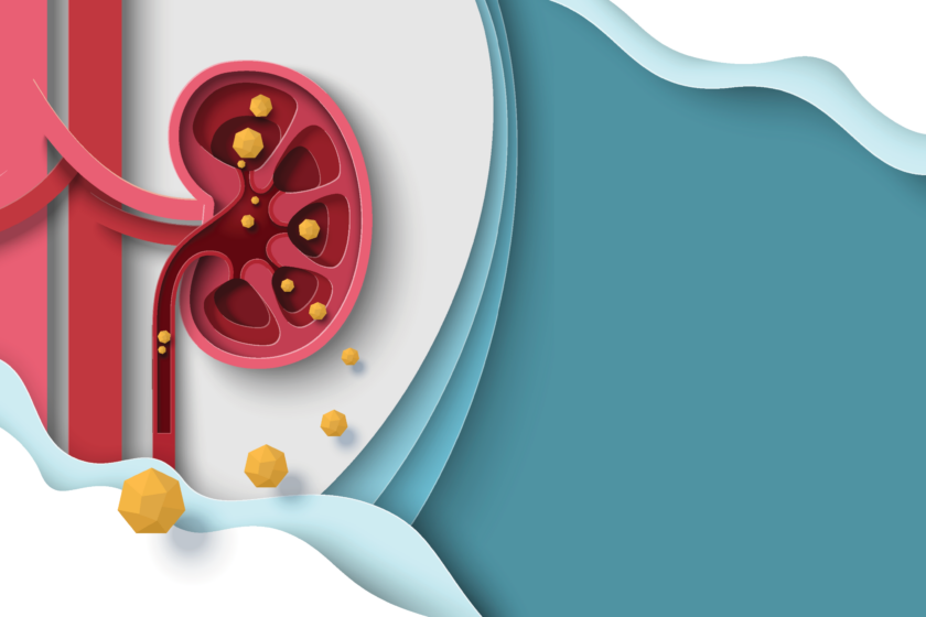 Illustration of kidney with kidney stones