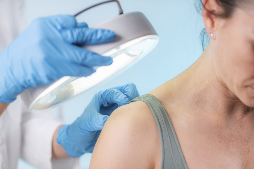 Dermatologist checking mole